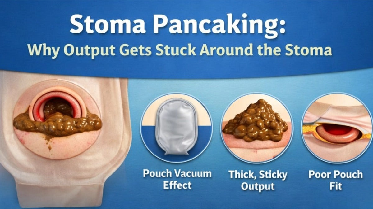 Stoma Pancaking: Why Output Gets Stuck Around the Stoma
