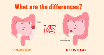Colostomy vs ileostomy differences showing stoma location