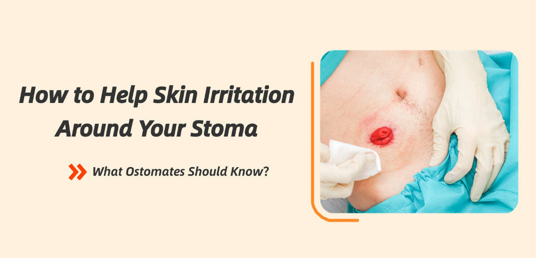 How to Help Skin Irritation Around Your Stoma