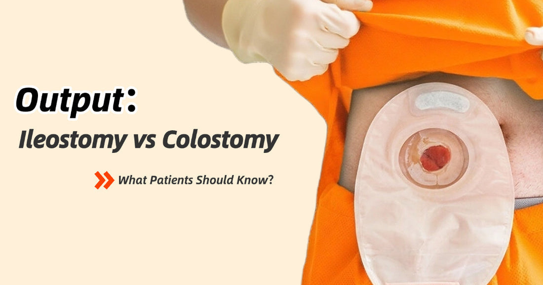 Ileostomy vs Colostomy Output: What Patients Should Know