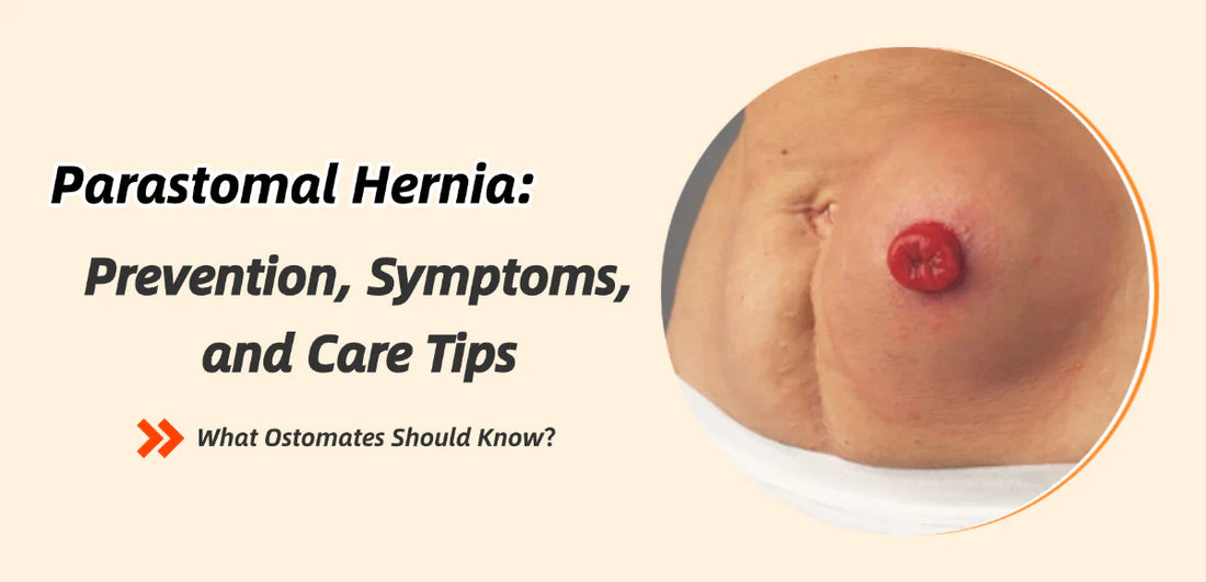 Parastomal Hernia: Prevention, Symptoms, and Care Tips