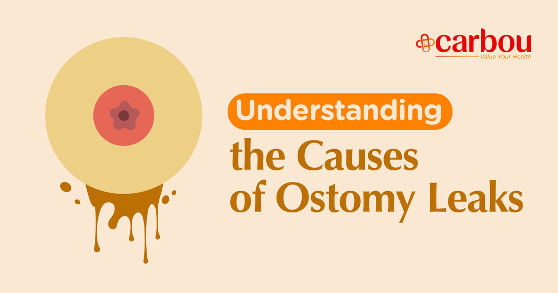 Understanding the Causes of Ostomy Leaks