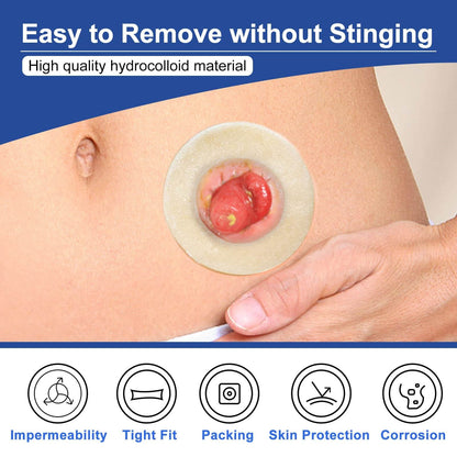 Carbou hydrocolloid barrier ring is easy to remove