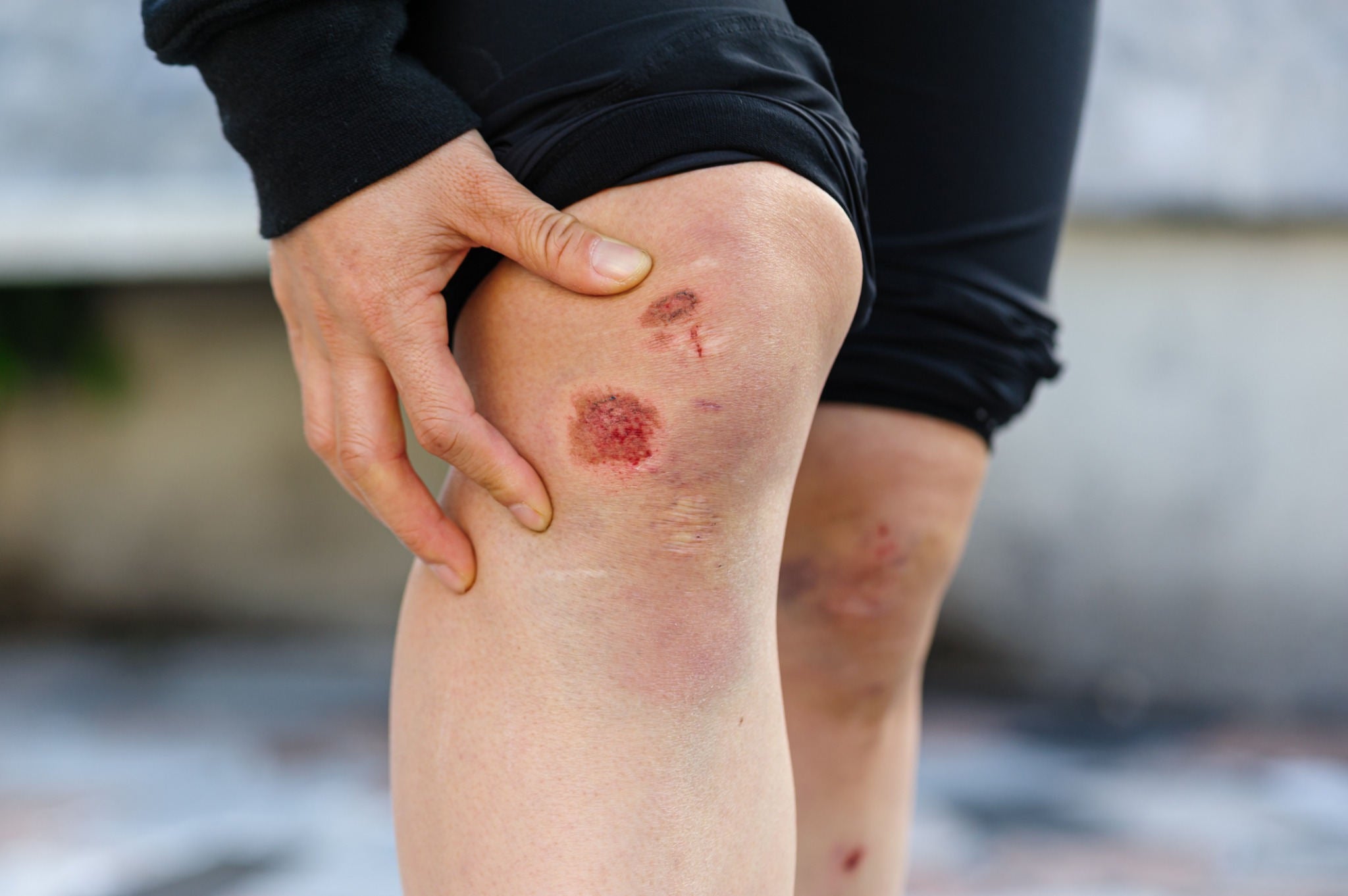 Knee abrasion with redness and drainage risk—when to avoid hydrocolloid dressing on infected wound.
